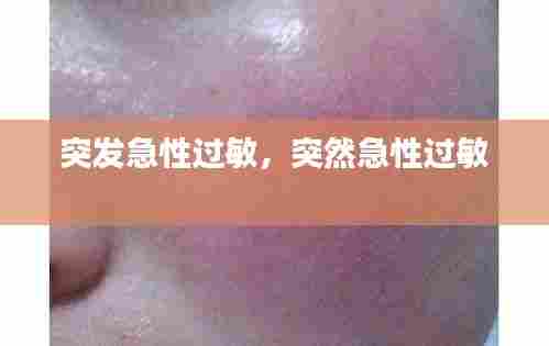 突发急性过敏，突然急性过敏 