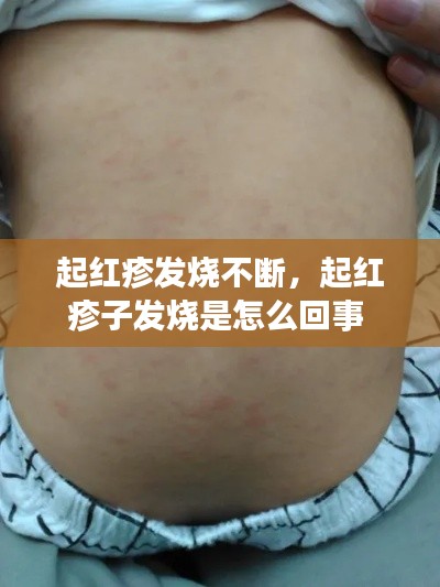 起红疹发烧不断，起红疹子发烧是怎么回事 