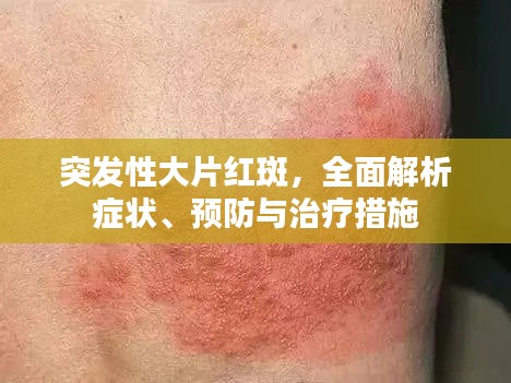 突发性大片红斑，全面解析症状、预防与治疗措施